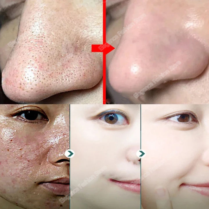 Salicylic%20Acid%20Pores%20Shrink%20Refining%20Cream%20Treatments%20Large%20Open%20Pore%20Remove%20Black%20Dots%20Blackhead%20Acne%20Marks%20Face%20Skin%20Products%20-%20Image%202