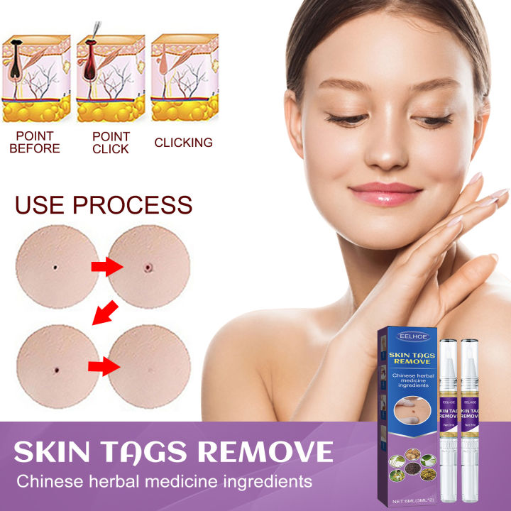 EELHOE%20Skin%20Care%20Gram%20Wart%20Liquid%20Desalination%20Nevus%20Pen%20Hand,%20Foot,%20Face%20And%20Neck%20Flesh%20Grain%20Skin%20Tag%20Removal%20Pen%20-%20Image%202