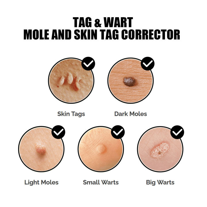 EELHOE%20Mole%20Removal%20Serum%20Repair%20To%20Remove%20Skin%20Moles%20And%20Spots%20Serum%20Flesh%20Moles%20Flat%20Wart%20Wart%20Removal%20Serum%20-%20Image%203