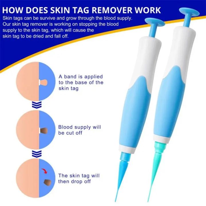 2%20In1%20Painless%20Auto%20Skin%20Tag%20Mole%20Wart%20Removal%20Kit%20Cleaning%20Tools%20Face%20Skin%20Care%20Body%20Wart%20Dot%20Treatments%20Remover%20Beauty%20Health%20Vnce%20Lncei%20-%20Image%203