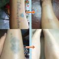 Tattoo Flaw Conceal Tape Full Cover Concealer Sticker Waterproof Scar Cover Suitable for Any Skin Type Concealing Tape Pad. 