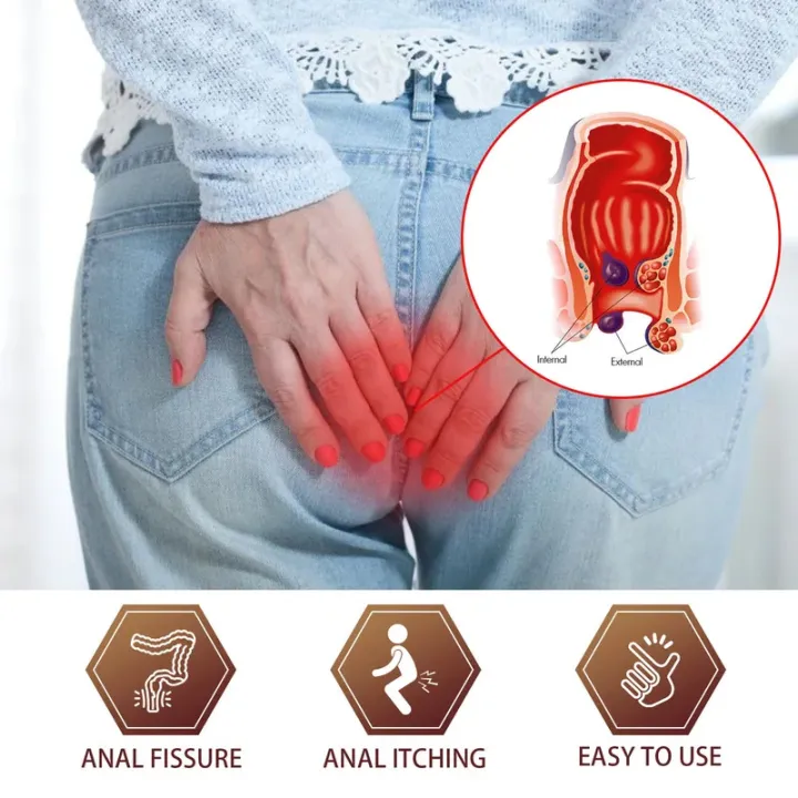 Hemorrhoid%20Relief%20Cream%20External%20Anal%20Fissure%20Therapy%20Internal%20Swell%20Bleed%20Treatment%20Anti%20Meatball%20Anal%20Itching%20Herbal%20Ointment%20-%20Image%203