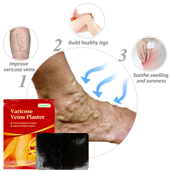 6Pcs%20Leg%20Patches%20For%20Varicose%20Veins%20Chinese%20Herbal%20Medicine%20Varicosity%20Angiitis%20Removal%20Phlebitis%20Spider%20Leg%20Veins%20Pain%20Plaster%20-%20Image%205