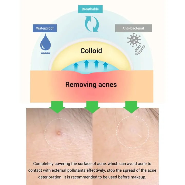 %E3%80%90DIV%20MALL%E3%80%91Patch%20Pimple%20Stickers%20Pimple%20Remover%20Spot%20Facial%20Mask%20-%20Image%205