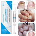 Gentle ingredients skin friendly and no side effect 3ML Fungal Nail Treatment Pen Onychomycosis Paronychia Anti Fungal Nail Infection Chinese Herbal. 