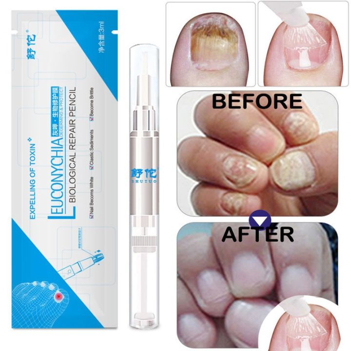Gentle ingredients skin friendly and no side effect 3ML Fungal Nail Treatment Pen Onychomycosis Paronychia Anti Fungal Nail Infection Chinese Herbal
