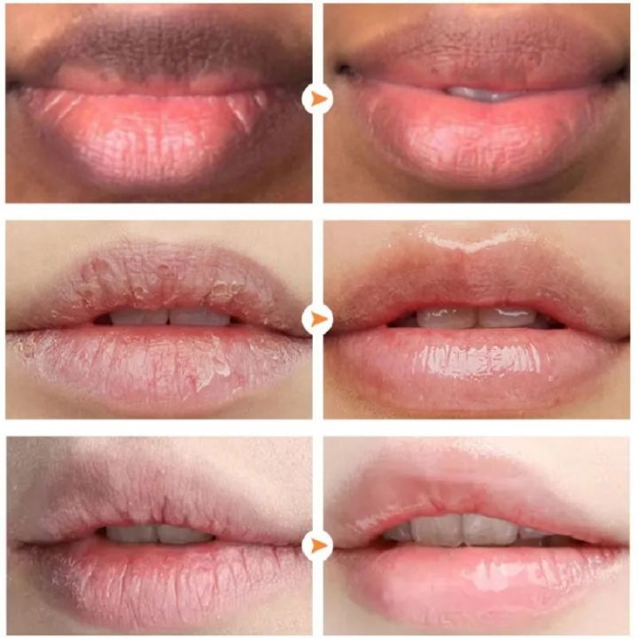 Lip%20Lightening%20Dark%20Lips%20Bleach%20Lips%20Whiten%20Remove%20Dull%20Black%20Lip%20Deep%20Nourish%20Fade%20Lip%20Lines%20Moisturize%20Bright%20-%20Image%204