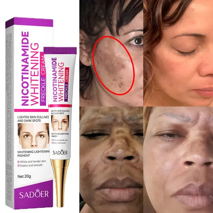 SADOER%20Niacinamide%20Whitening%20Freckle%20Cream%20Effectively%20Removes%20Melasma%20Lightens%20Black%20Spots%20Acne%20Marks%20Brightens%20Skin%20Care-20gm%20-%20Image%204