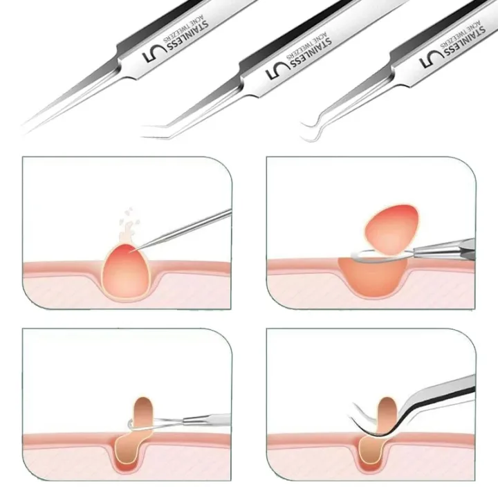 Blackhead%20Acne%20Pimple%20Remover%20Tool%20Facial%20Skin%20Care%20Products%20Kit%20Pinzas%20Para%20Espinillas%20Black%20Head%20Removal%20Tweezers%20Face%20Cleaner%20-%20Image%203