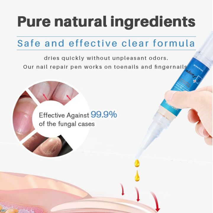 Repair%20Nail%20Fungus%20Treatments%20Essence%20Foot%20Care%20Serum%20Toe%20Nails%20Fungal%20Removal%20Gel%20Anti-Infection%20Onychomycosis%20Nail%20Care%204ml%20-%20Image%202