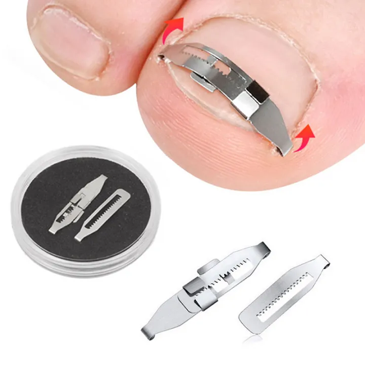 Pedicure%20Recover%20Embed%20Toe%20Nail%20Ingrown%20Toenail%20Corrector%20Treatment%20Foot%20Tools%20-%20Image%202