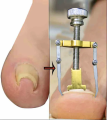 Nail Care machine for nail repair Pedicure Correction Tool Foot Correcting Device Ingrown Toenail Fixer Toe nail Recover-The Asia Express. 