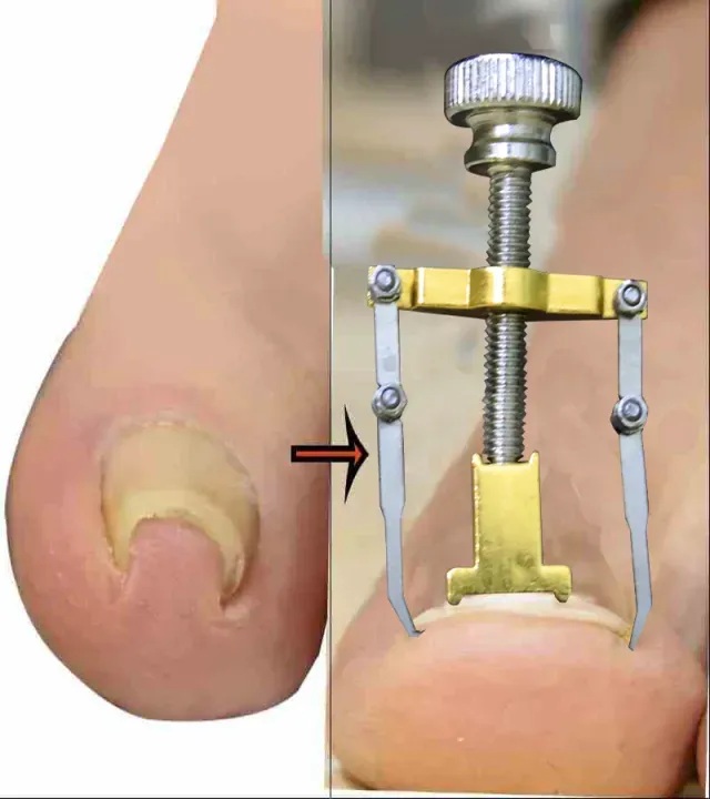 Nail%20Care%20machine%20for%20nail%20repair%20Pedicure%20Correction%20Tool%20Foot%20Correcting%20Device%20Ingrown%20Toenail%20Fixer%20Toe%20nail%20Recover-The%20Asia%20Express%20-%20Image%202