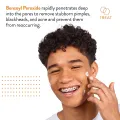 AcneFree Terminator 10 Acne Spot Treatment with Benzoyl Peroxide 10% Maximum Strength Acne Cream Treatment, 30mL. 