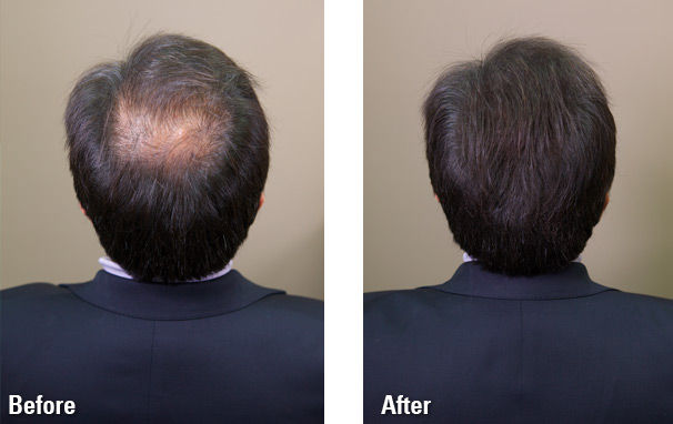 Pack%20of%202%20Toppik%20Hair%20Building%20Fiber%20Black%2027.5%20gm%20-%20Image%203