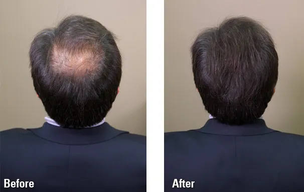 Caboki%2030g%20Premium%20Hair%20Building%20Fiber%20Black%20for%20Thinning%20Hair%20-%20Single%20Pack%20-%20Image%203