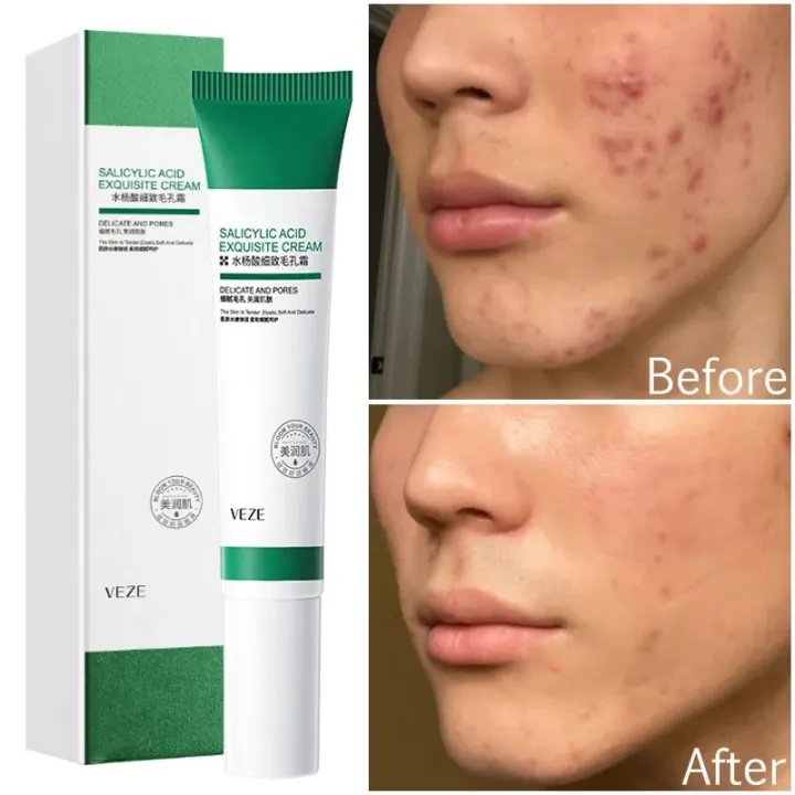 Salicylic%20Acid%20Pores%20Refining%20Cream%20Shrink%20Pore%20Improve%20Acne%20Blackheads%20Oil%20Control%20Cream%20Moisturizing%20Face%20Skin%20Care%2020ml%20Vnce%20Lncei%20-%20Image%202