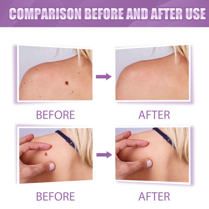 EELHOE%20Skin%20Care%20Gram%20Wart%20Liquid%20Desalination%20Nevus%20Pen%20Hand,%20Foot,%20Face%20And%20Neck%20Flesh%20Grain%20Skin%20Tag%20Removal%20Pen%20-%20Image%203