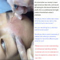 TCA 20% 30% 35% 40% 50% 60% 70% Pure TCA Peel Solution for Sun Damage Fine Lines Wrinkles Dull Skin Uneven Skin Tone Enlarged Po. 