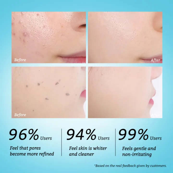 RtopR%20Facial%20Exfoliating%20Gel%20Facial%20Clean%20Cream%20Facial%20Scrub%20Blackhead%20Grease%20Dirt%20Oil%20Control%20Repairs%20Evens%20Tone%20Pore%20Tighten%20-%20Image%202