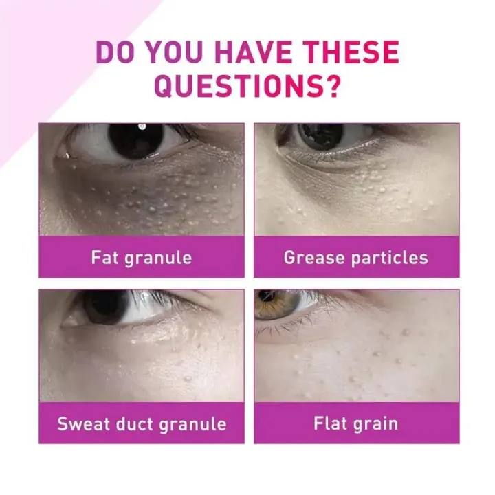 Fat%20Granules%20Removal%20Eye%20Serum%20Eye%20Milia%20Repair%20Treatment%20Products%20Wrinkle%20Lifting%20Moisturizing%20Anti-Puffiness%20Korean%20Skin%20Care%20-%20Image%203