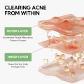 LANBENA Salicylic Acid Acne Spot Serum Cleanses Pores And Reduces Acne Oil Control Brightening Skin Acne Treatment Serum 10ml. 