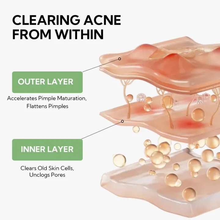 LANBENA%20Salicylic%20Acid%20Acne%20Spot%20Serum%20Cleanses%20Pores%20And%20Reduces%20Acne%20Oil%20Control%20Brightening%20Skin%20Acne%20Treatment%20Serum%2010ml%20-%20Image%206