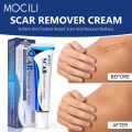 Acne Surgical Stretch Marks Removal Scar Cream Repair Smoothening Whitening Body Skin Care Pigmentation Beauty Cosmetics 20g AOutlierA. 
