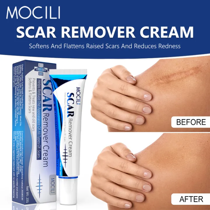Acne%20Surgical%20Stretch%20Marks%20Removal%20Scar%20Cream%20Repair%20Smoothening%20Whitening%20Body%20Skin%20Care%20Pigmentation%20Beauty%20Cosmetics%2020g%20AOutlierA%20-%20Image%203