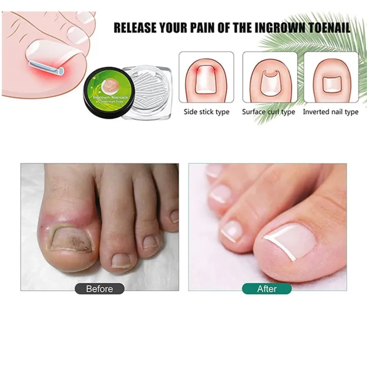 10PCS%20Ingrown%20Toenail%20Correction%20Tool%20Nail%20Treatment%20Toe%20Nail%20Sticker%20Foot%20Care%20Pedicure%20Foot%20Orthodontic%20Toe%20Thumb%20Nail%20Patches%20-%20Image%203