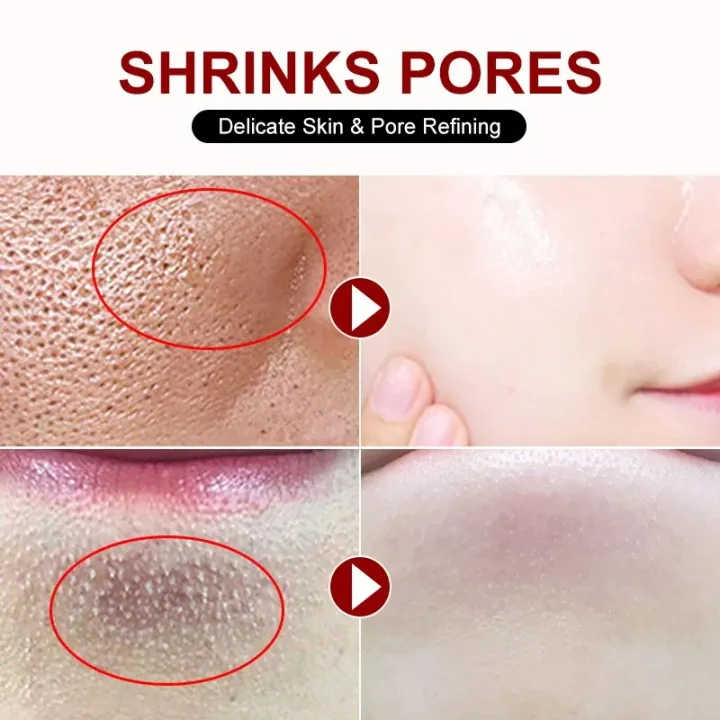 Salicylic%20Acid%20Pore%20Shrinking%20Cream%20Quick%20Elimination%20Large%20Pores%20Remove%20Blackehead%20Tighten%20Face%20Smooth%20Skin%20Care%20Product%20New%20-%20Image%202