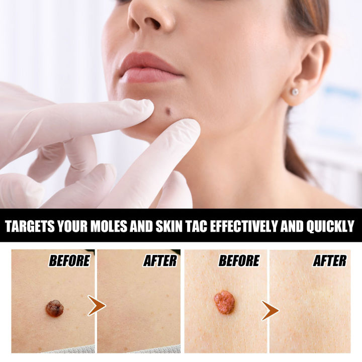 EELHOE%20Mole%20Removal%20Serum%20Repair%20To%20Remove%20Skin%20Moles%20And%20Spots%20Serum%20Flesh%20Moles%20Flat%20Wart%20Wart%20Removal%20Serum%20-%20Image%204