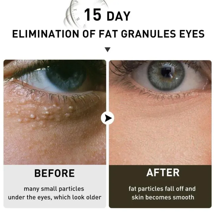 Fat%20Granules%20Removal%20Eye%20Serum%20Eye%20Milia%20Repair%20Treatment%20Products%20Wrinkle%20Lifting%20Moisturizing%20Anti-Puffiness%20Korean%20Skin%20Care%20-%20Image%204