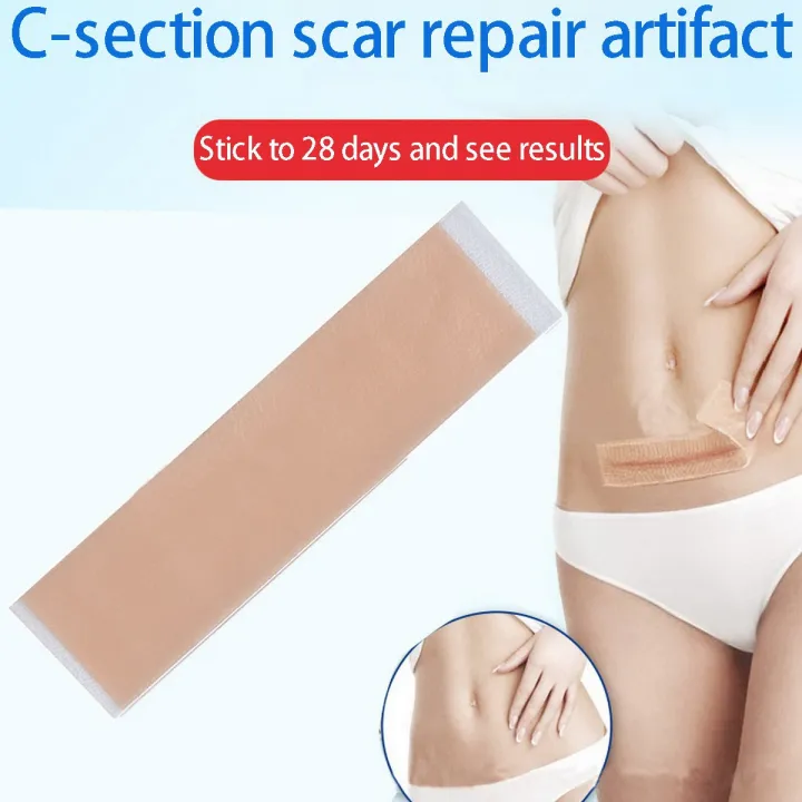 3PC%20Efficient%20Surgery%20Scar%20Removal%20Silicone%20Gel%20Sheet%20Therapy%20Patch%20for%20Acne%20Trauma%20Burn%20Scar%20Skin%20Repair%20Scar%20Treatment%20-%20Image%202