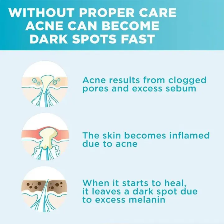 30ml%20Garnier%20Whitening%20Essence%20Removes%20Acne%20Marks%20Comedones%20Blackheads%20Facial%20Repair%20Serum%20Shrinks%20Pores%20Moisturizes%20Essence%20-%20Image%205