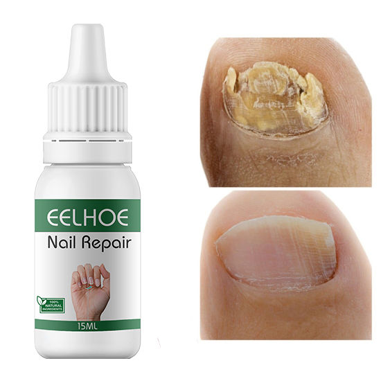 EELHOE Makes Your Nail Clean EELHOE Nail Repair Serum Nail Repair Oil 15ML