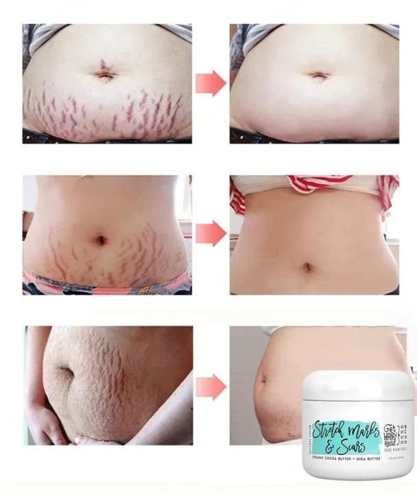 Natural%20Organic%20Postpartum%20Stretch%20Mark%20Removal%20Skin%20Repair%20Cream%20Body%20Pregnancy%20Scar%20Cream%20For%20Women%20-%20Image%205