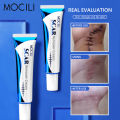 Acne Surgical Stretch Marks Removal Scar Cream Repair Smoothening Whitening Body Skin Care Pigmentation Beauty Cosmetics 20g AOutlierA. 
