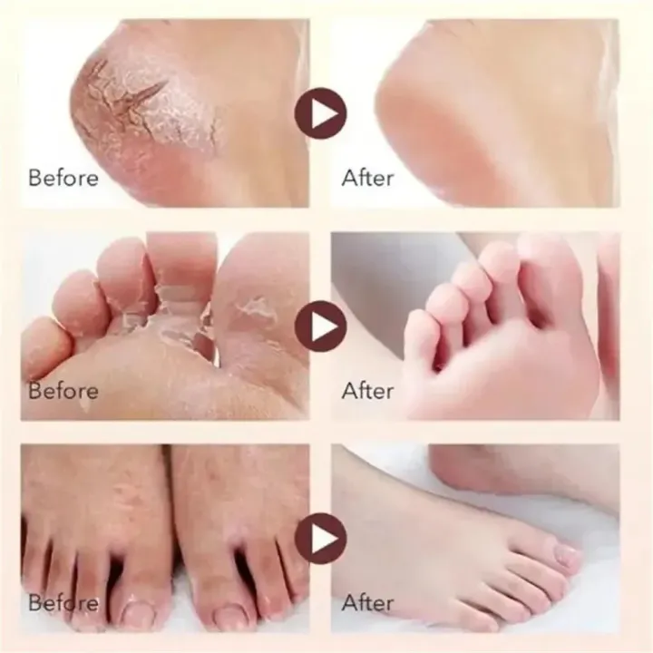 EELHOE%20Anti%20Crack%20Foot%20Hand%20Gel%20Ginger%20%20Cuticles%20Care%20Anti-Drying%20Healing%20Crack%20Frost%20Mask%20Dead%20Skin%20Removal%20Deep%20Moisturizing%20Feet%20Crack%20Whitening%20Smooth%20Feet%20Care%20-%20Image%206