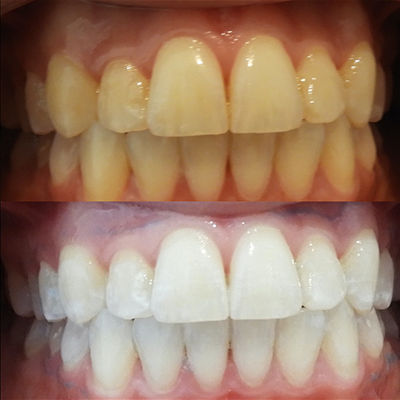 ELHOE%20Teeth%20Whitening%20Drops%20%E2%80%93%20100%25%20Natural%20Herbal%20Formula%20%E2%80%93%20Instantly%20Whitens%20Yellow%20Teeth,%20Removes%20Stains,%20Fights%20Bad%20Breath%20&%20Plaque%20%E2%80%93%20Strengthens%20Gums%20&%20Enamel%20%E2%80%93%20Safe%20for%20Sensitive%20Teeth%20%E2%80%93%20Fluoride-Free%20Liquid%20Oral%20Care%20for%20Men%20&%20Women%20-%20Image%206