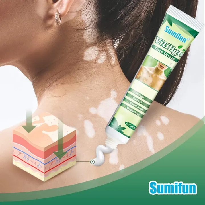 Sumifun%20Vitiligo%20Care%20Cream,%20Vitiligo%20Treatment,%20Reduces%20White%20Spots%20on%20Skin,%20Pigmentation%20regulating%2020G%20-%20Image%205