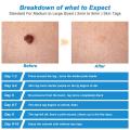 2 IN 1 Auto Micro Skin Tag Remover Pen Standard Micro Skin Tag Removal Kit.
