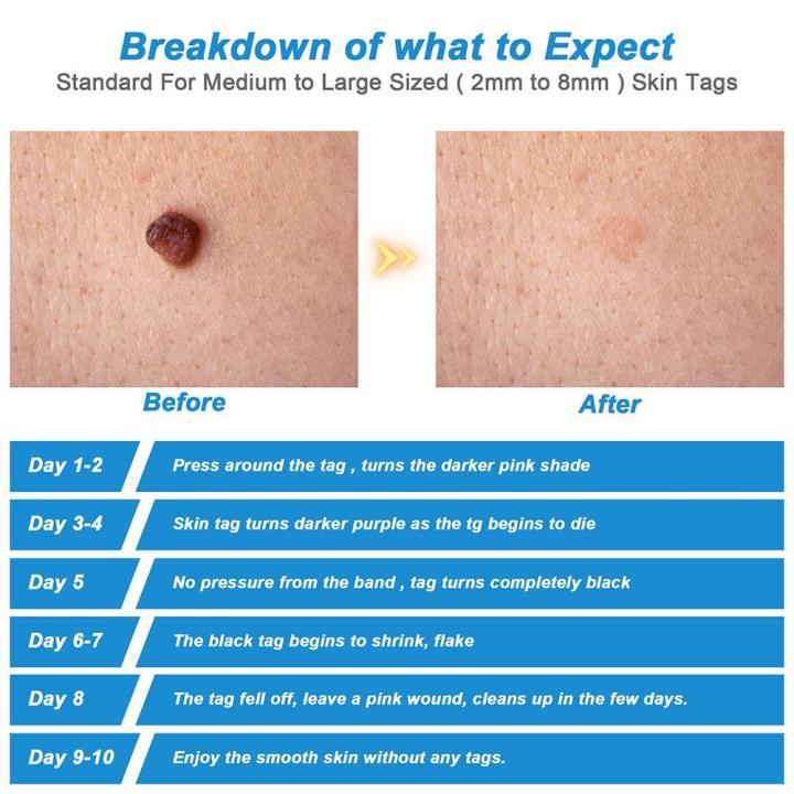 2%20IN%201%20Auto%20Micro%20Skin%20Tag%20Remover%20Pen%20Standard%20Micro%20Skin%20Tag%20Removal%20Kit%20-%20Image%208