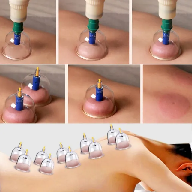 Hijama/Cupping/Sunnah%20Therapy%201%20set%20with%2032%20pcs%20cup%20-%20Image%208