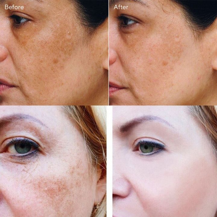%E3%80%90The%20Edge%20of%20Beauty%E3%80%91Whitening%20freckle%20cream%20remove%20melasma%20melanin%20spots%20lightening%20cream%20-%20Image%204