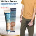 20g Vitiligo Removal Cream Natural Herbal White Spot Treatment Ointment Fast Acting Leukoplakia Vitiligo Cream Health Care Cream. 