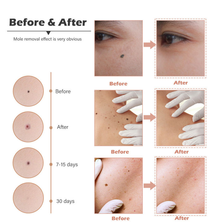 LCD%20Plasma%20Removal%20Pen%20Face%20Wart%20Freckle%20Remover%20Machine%20Mole%20Dark%20Spot%20Skin%20Tag%20Removal%209%20Level%20USB%20Charge%20Beauty%20Salon%20-%20Image%208
