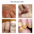 Repair Nail Fungus Treatments Essence Foot Care Serum Toe Nails Fungal Removal Gel Anti-Infection Onychomycosis Nail Care 4ml. 