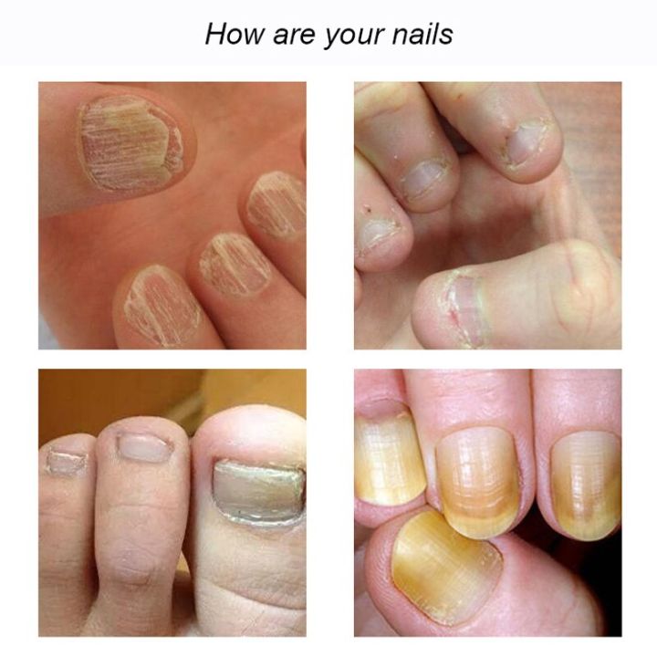 Repair%20Nail%20Fungus%20Treatments%20Essence%20Foot%20Care%20Serum%20Toe%20Nails%20Fungal%20Removal%20Gel%20Anti-Infection%20Onychomycosis%20Nail%20Care%204ml%20-%20Image%204