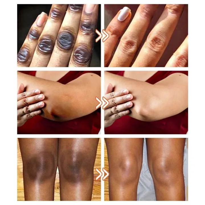 Intimate%20Area%20Whitening%20Cream%20Pink%20Body%20Serum%20Lighten%20Melanin%20Underarms%20Hips%20Inner%20Thighs%20Brightening%20Repair%20Private%20Part%20Care%20-%20Image%203